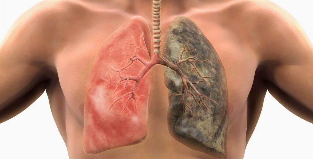 BOLILE PULMONARE – CAUZE , SIMPTOME ȘI METODE DE PREVENȚIE